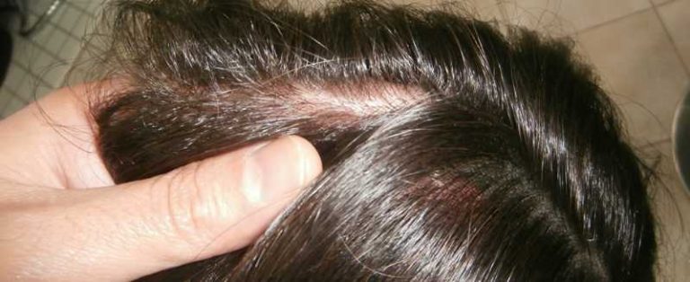 curare alopecia